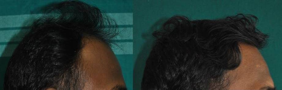 Hair implant in Ernakulam